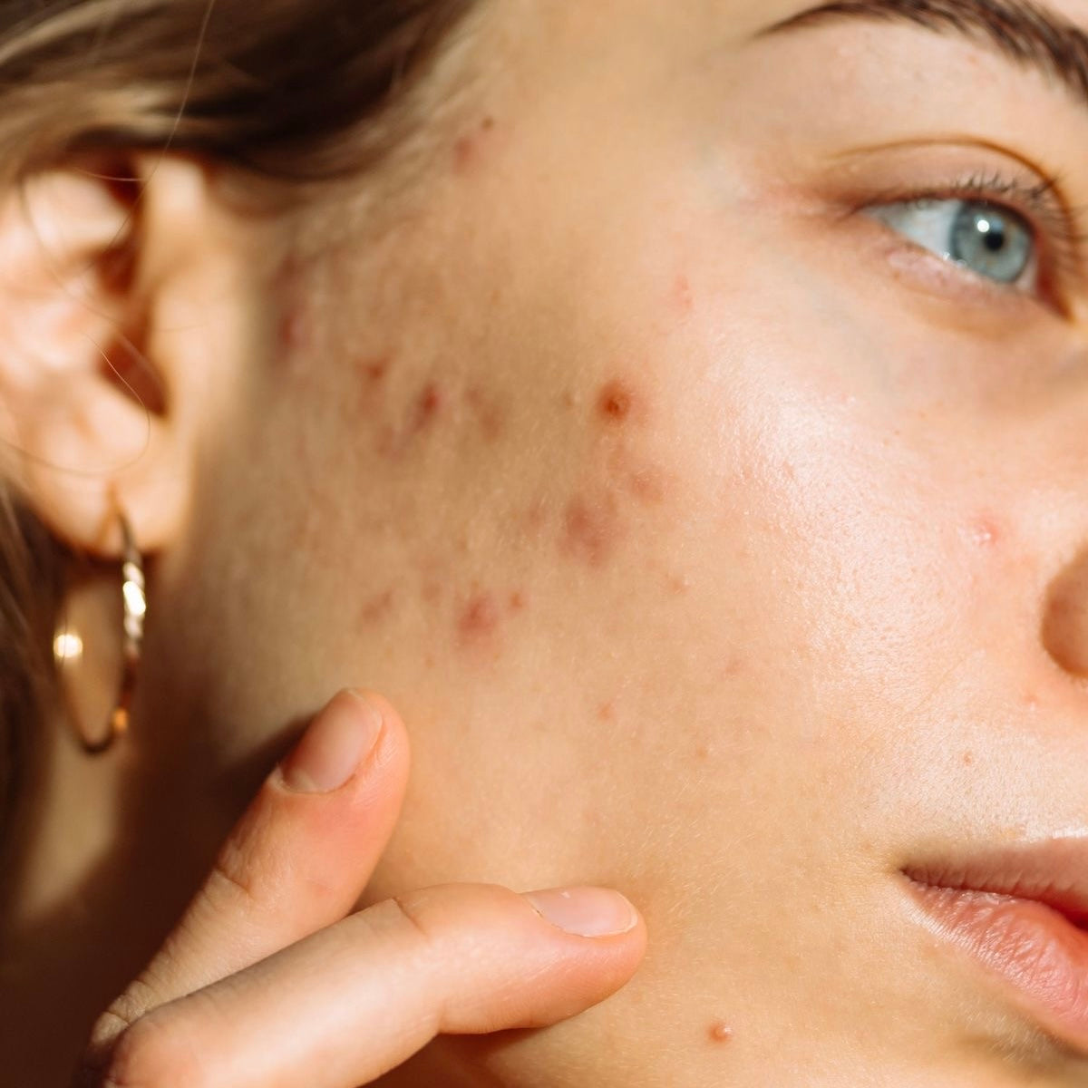 Acne Skincare Products