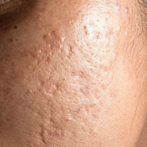 Scarring Skincare Products