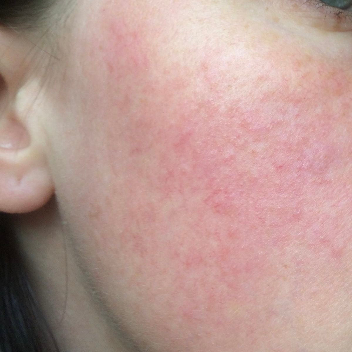 Rosacea Skincare Products